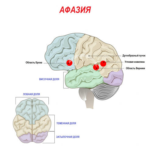 Афазия: виды, причины, способы преодоления